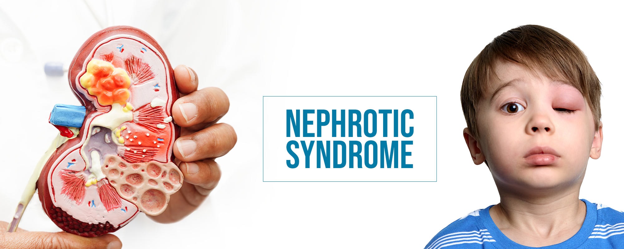 Homeopathy Treatment for Nephrotic Syndrome - Dr Care Homeopathy Kidney Expert