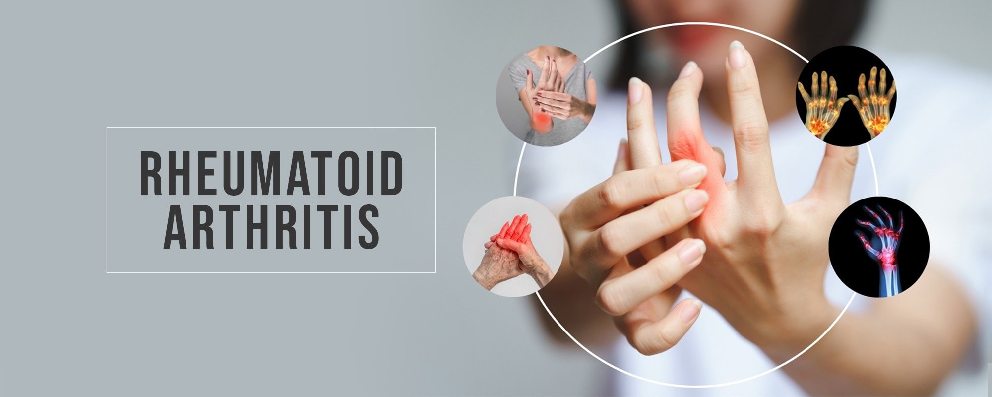 Homeopathic treatment for rheumatoid arthritis and joint inflammation in Hyderabad - Dr Care Homeopathy