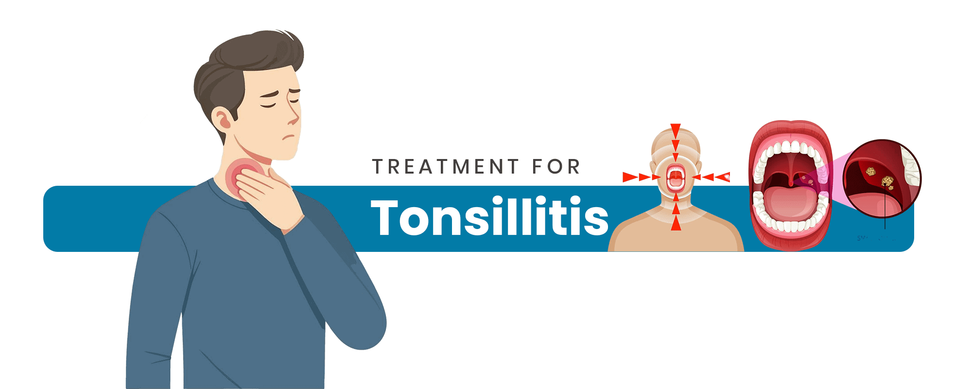 Homeopathy Treatment for Tonsillitis – Permanent, Surgery-Free Relief for Children & Adults Without Antibiotics