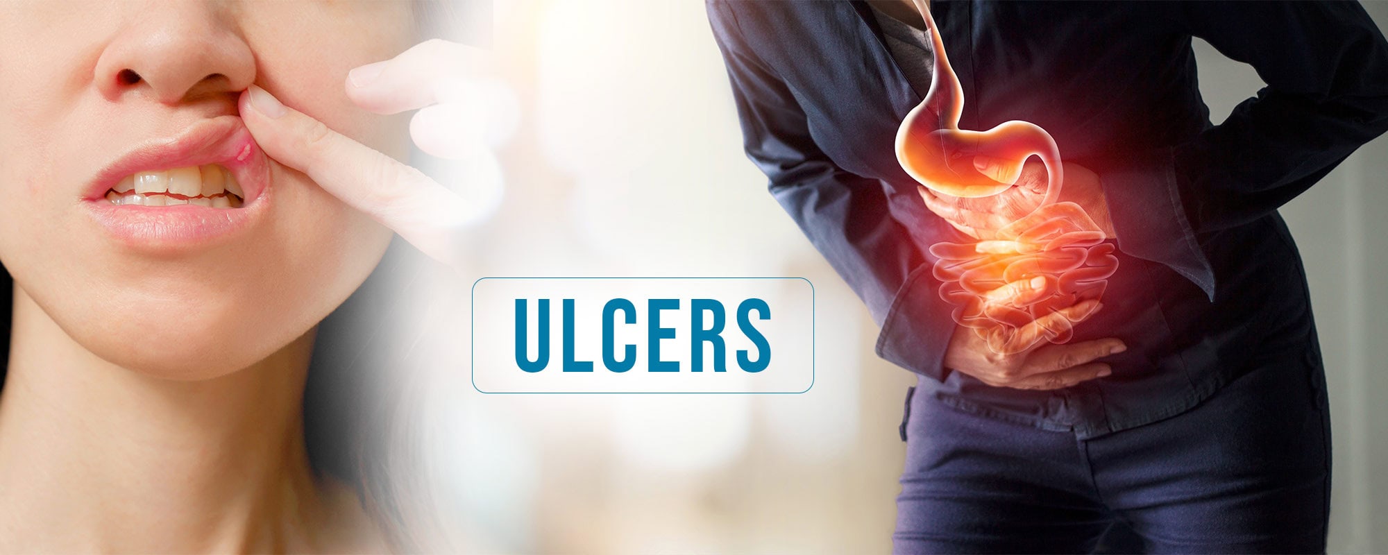Homeopathy Treatment for Ulcers – Heal Stomach, Peptic & Duodenal Ulcers Permanently Without Surgery