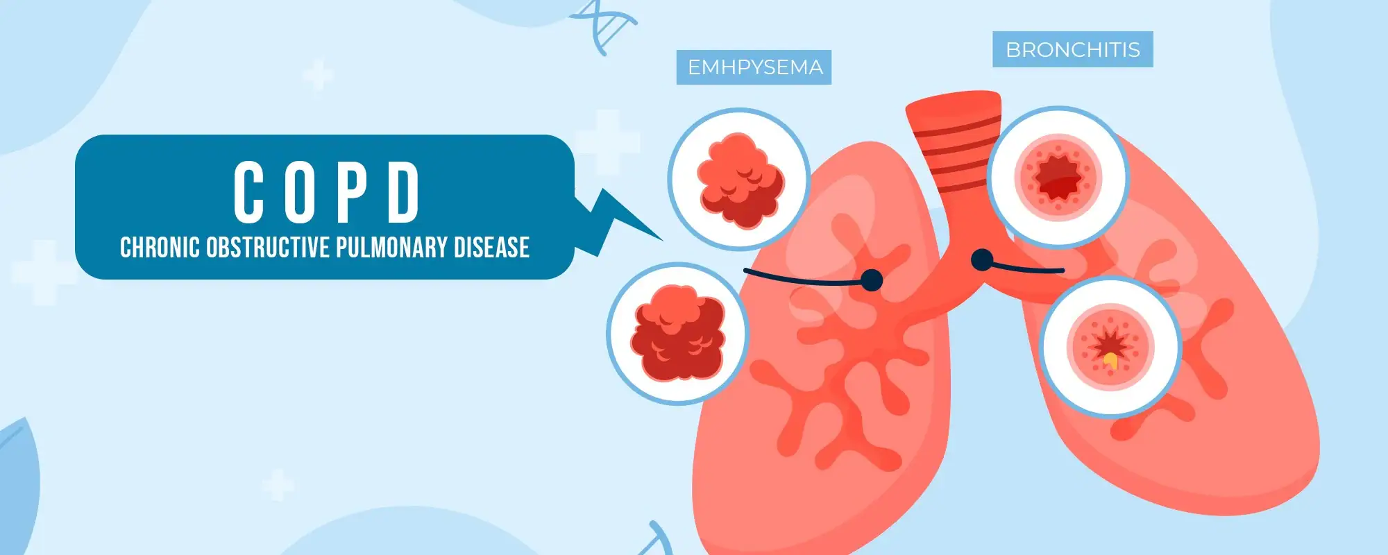 COPD-treatment