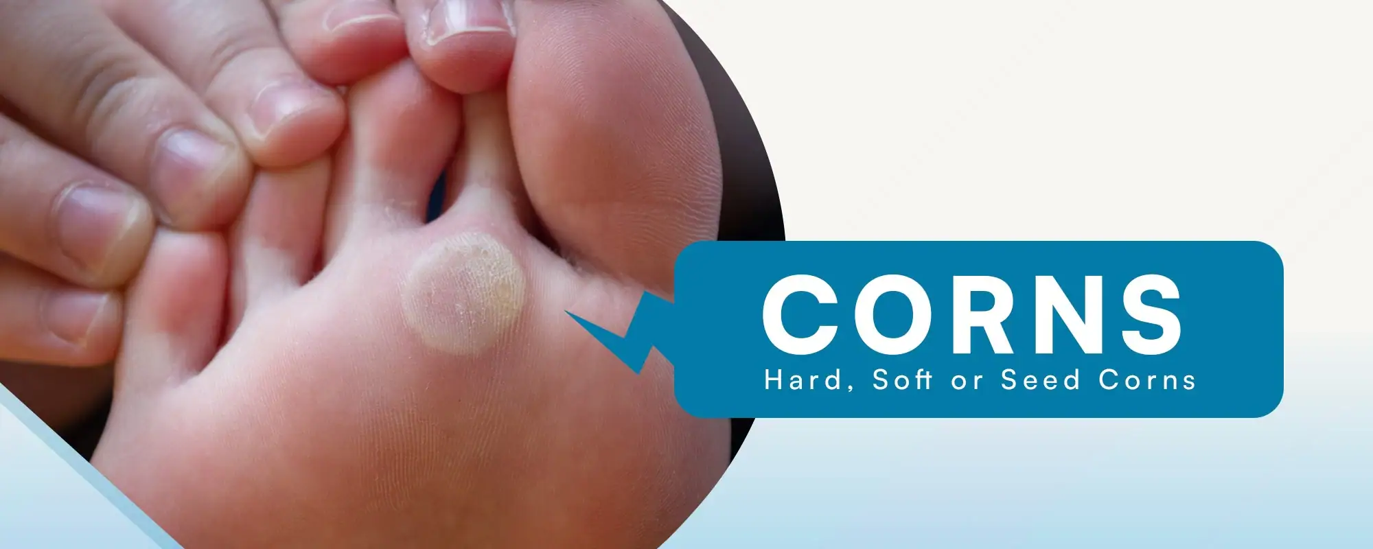 Corns-Treatment