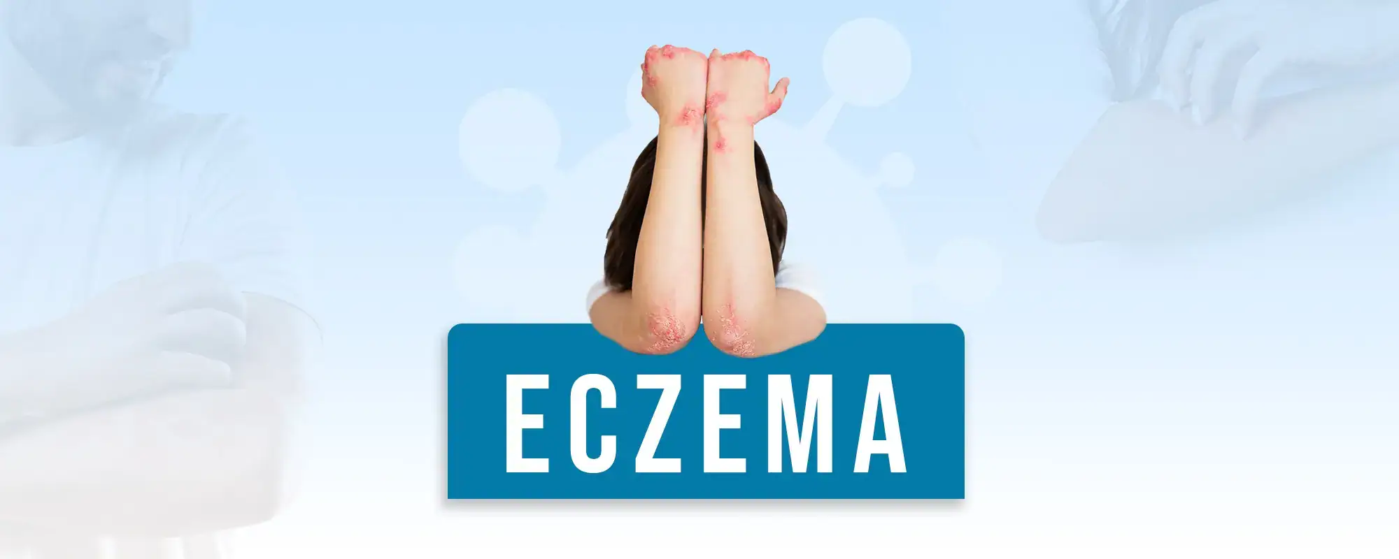 Eczema-Treatments