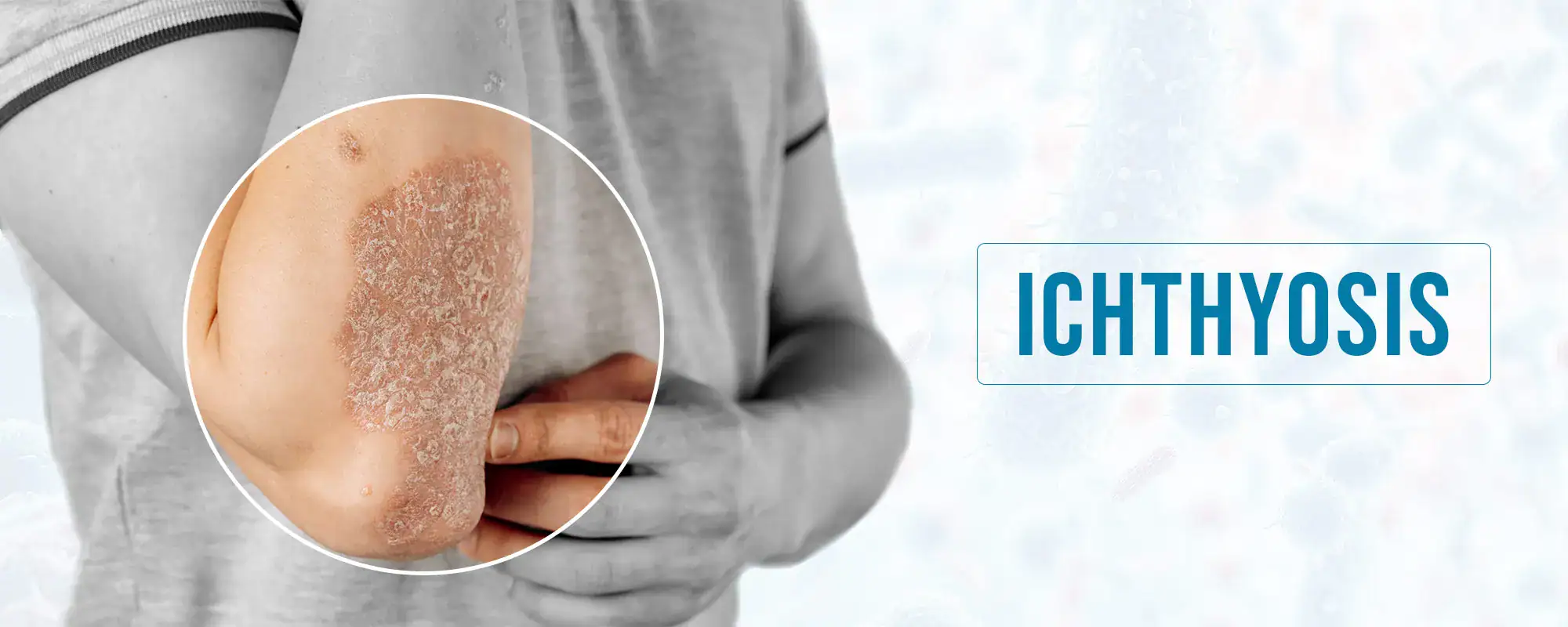 Ichthyosis-Treatments-Banner