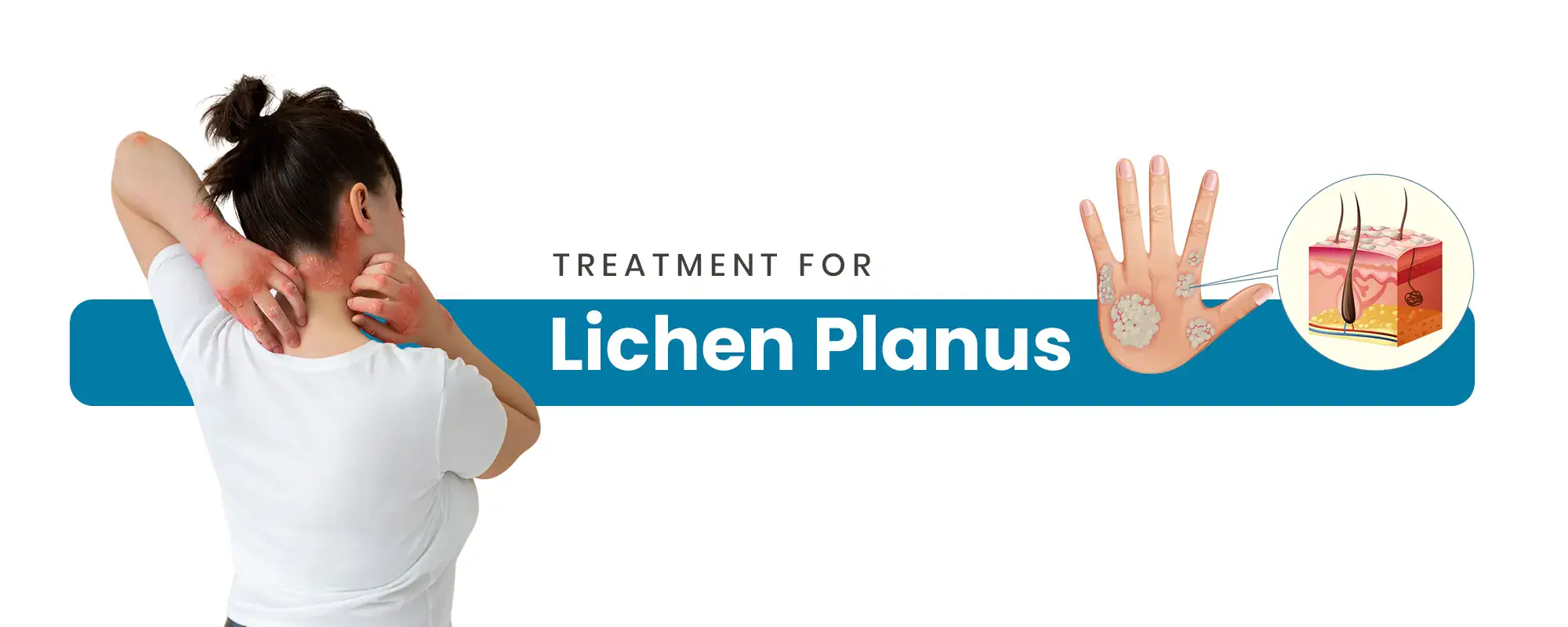 Lichen-Planus-Treatment