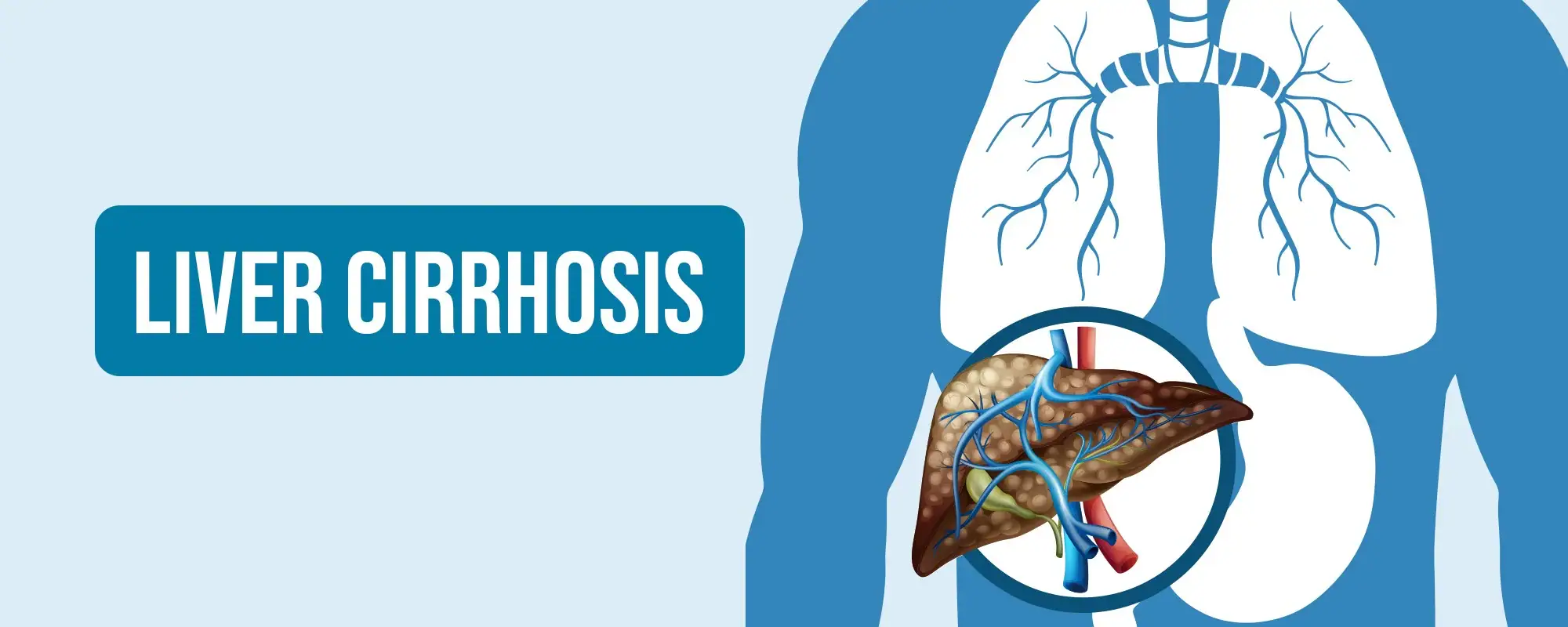 Liver-Cirrhosis-Treatments