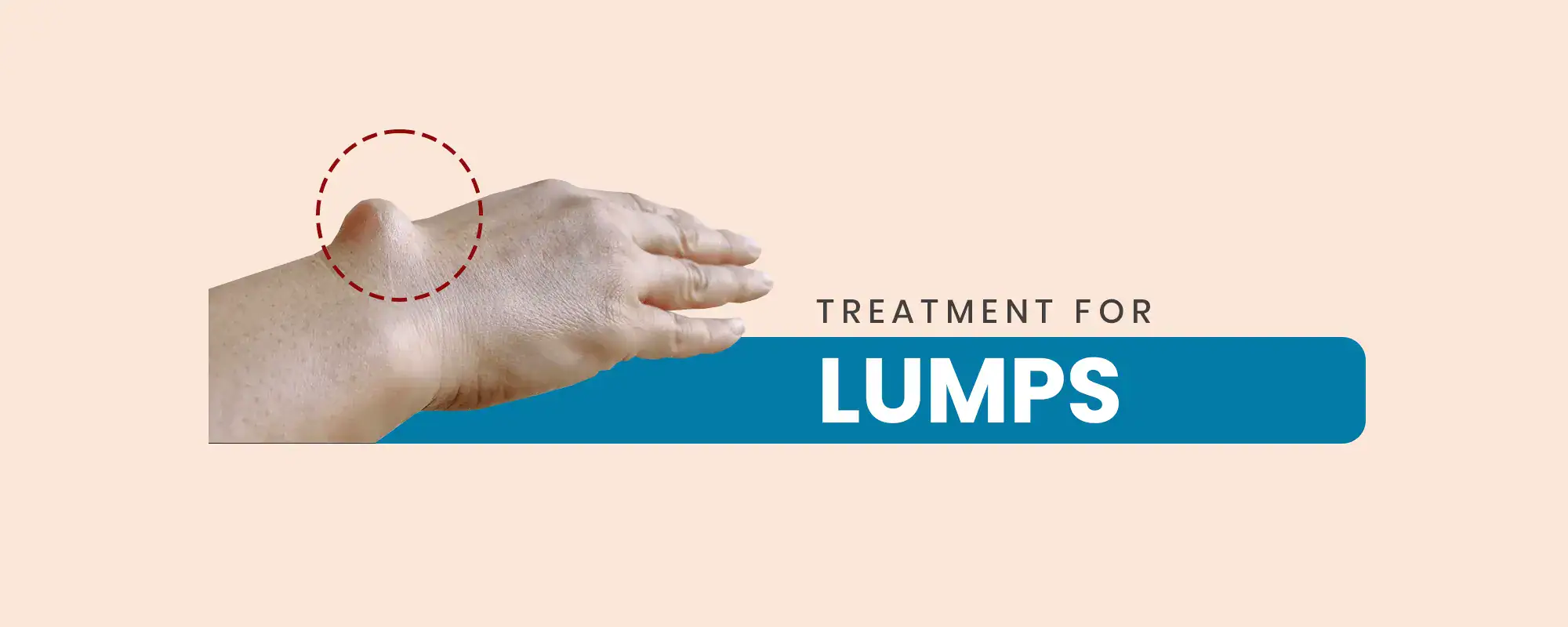 Lumps-Treatments