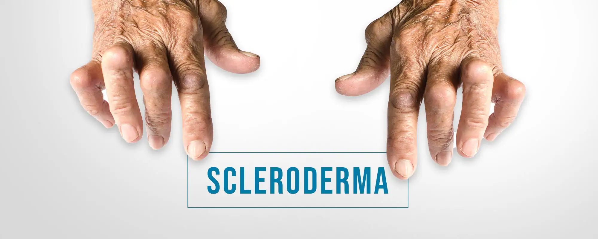 Scleroderma-Treatments