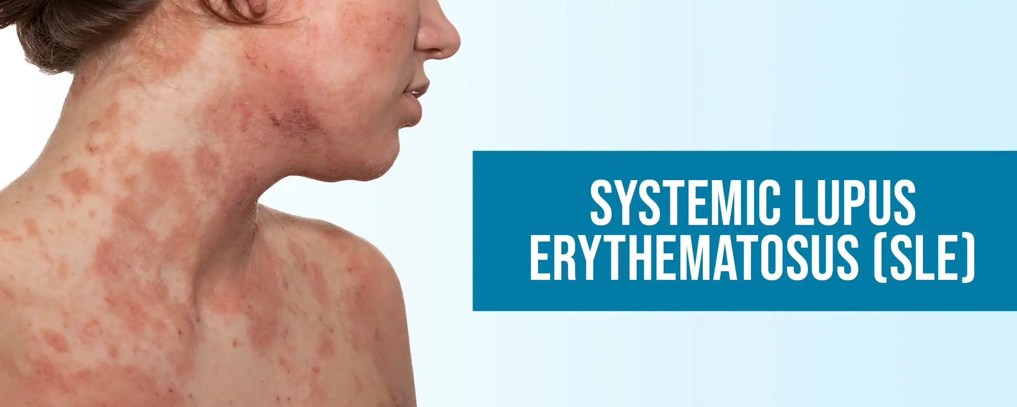 Systemic-Lupus-Erythematosus-SLE-Treatments