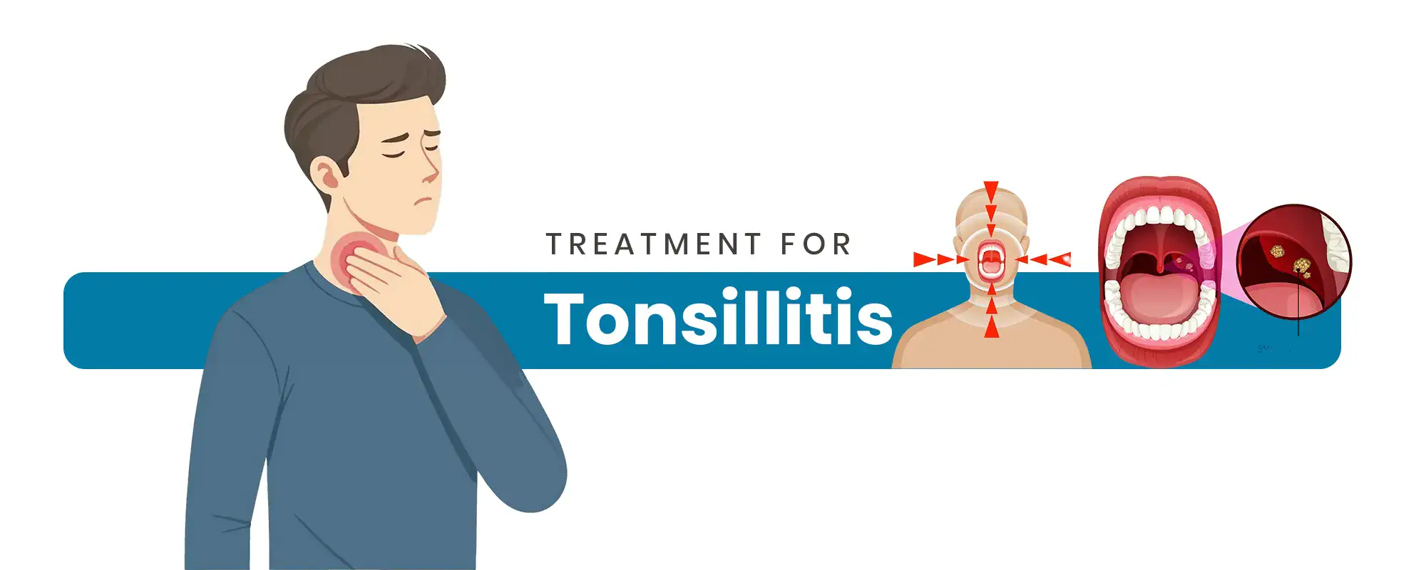 Tonsillitis