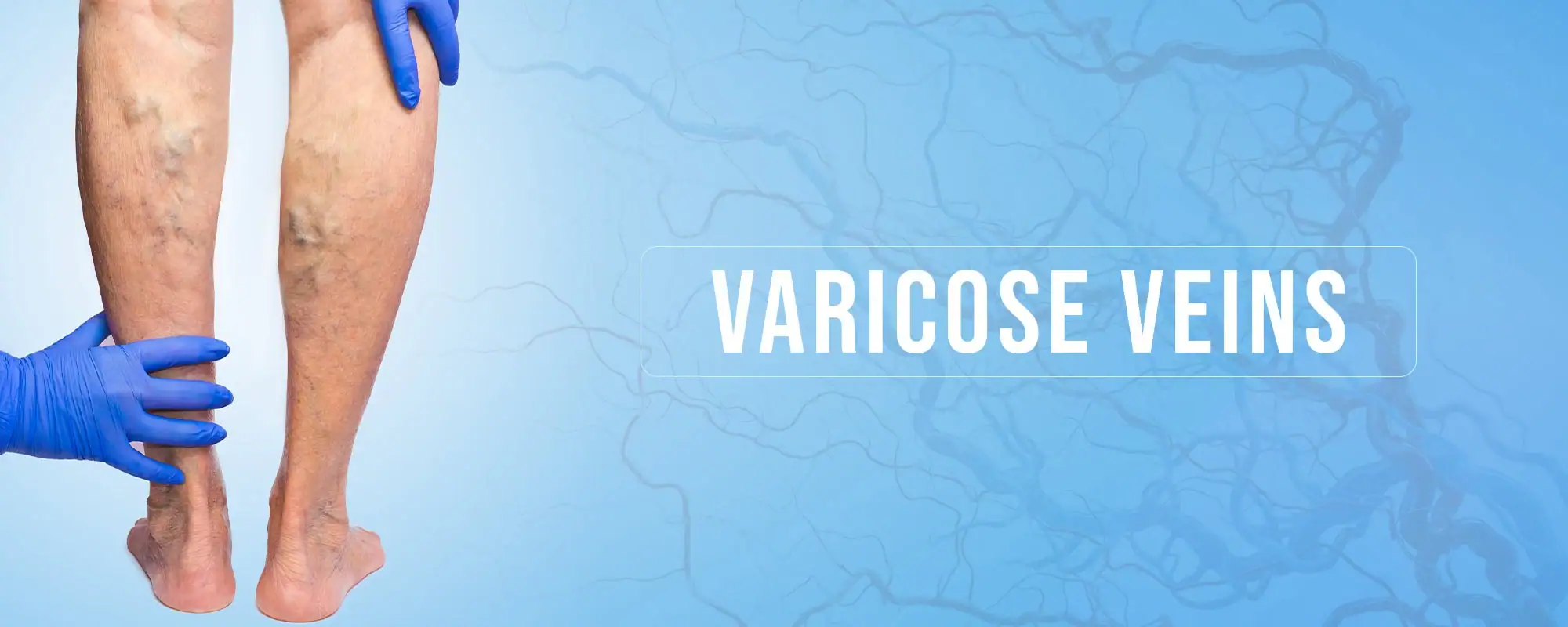 Varicose-Veins-Treatments
