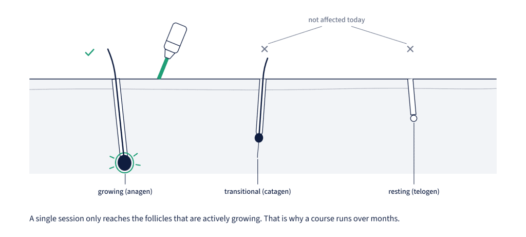 Diagram showing hair follicles in growing, transitional and resting phases, with the laser only affecting actively growing follicles