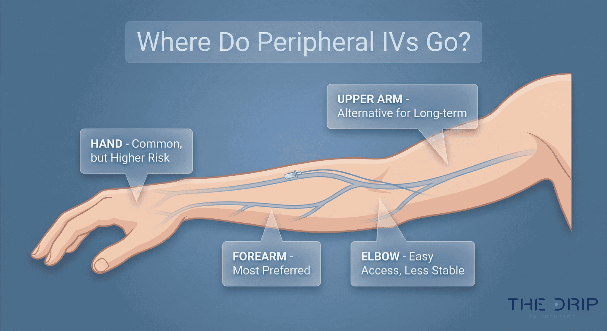 Infographic showing labeled arm veins used for peripheral IV insertion, including forearm, hand, and elbow sites.
