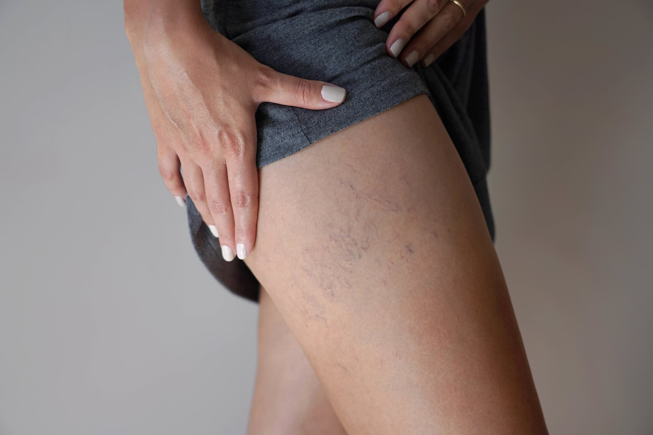 Front Page Close-up of spider veins on leg | Spider vein treatment by board-certified vein specialists at The Vein Guys.