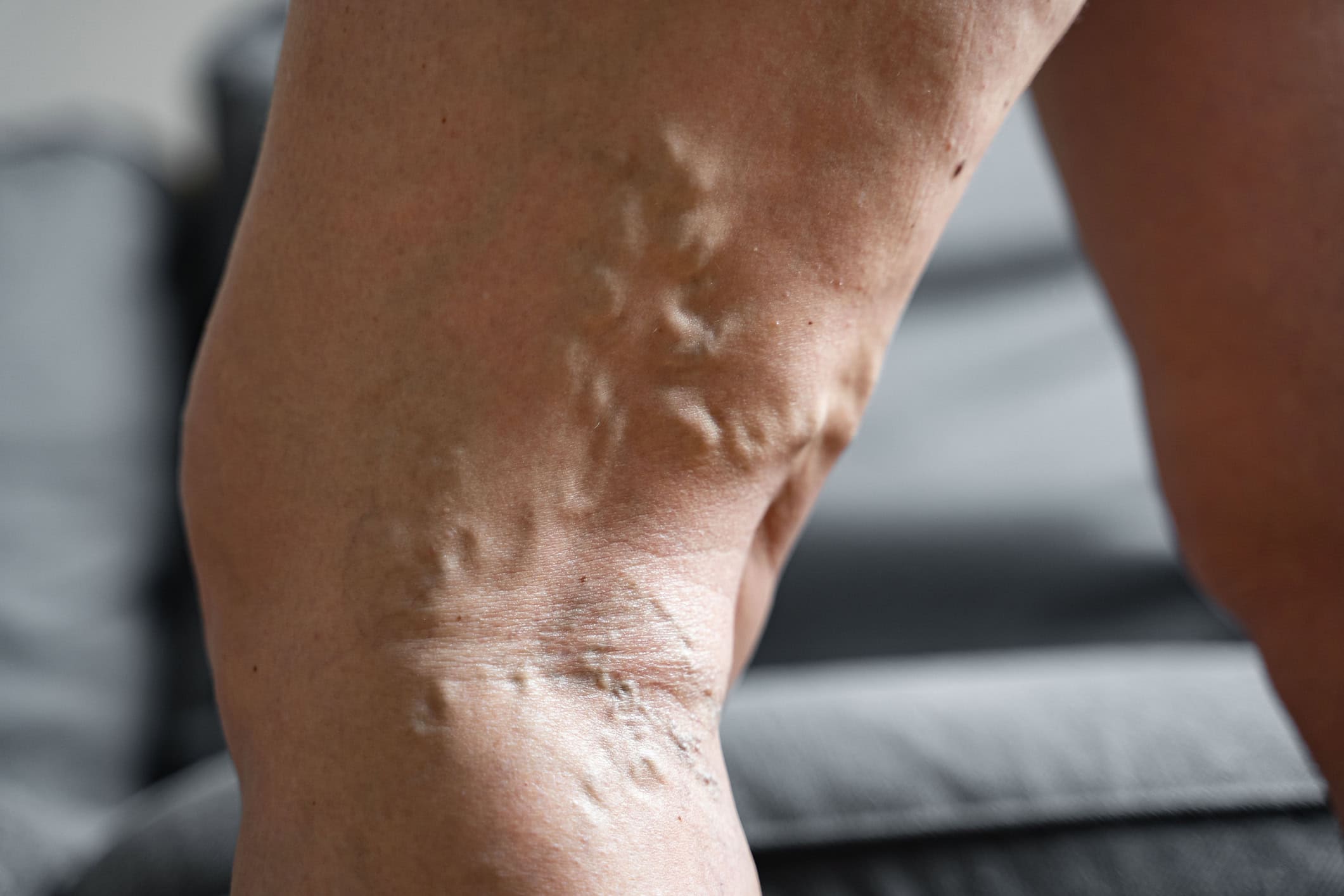 Front Page Close-up of varicose veins on leg | Vein specialist treatment options at The Vein Guys.