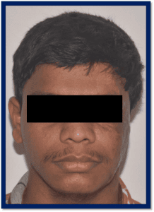 Ear Prosthesis Before