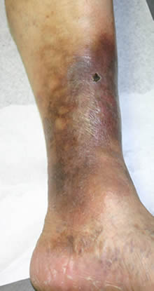 Varicose Veins_4