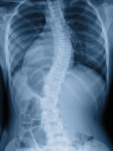 X-ray of spine with scoliosis