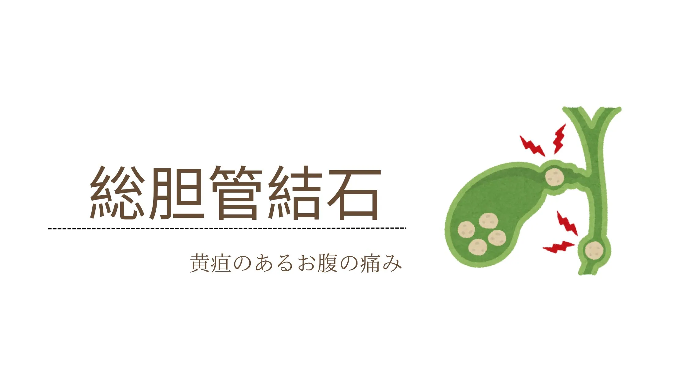 総胆管結石とは