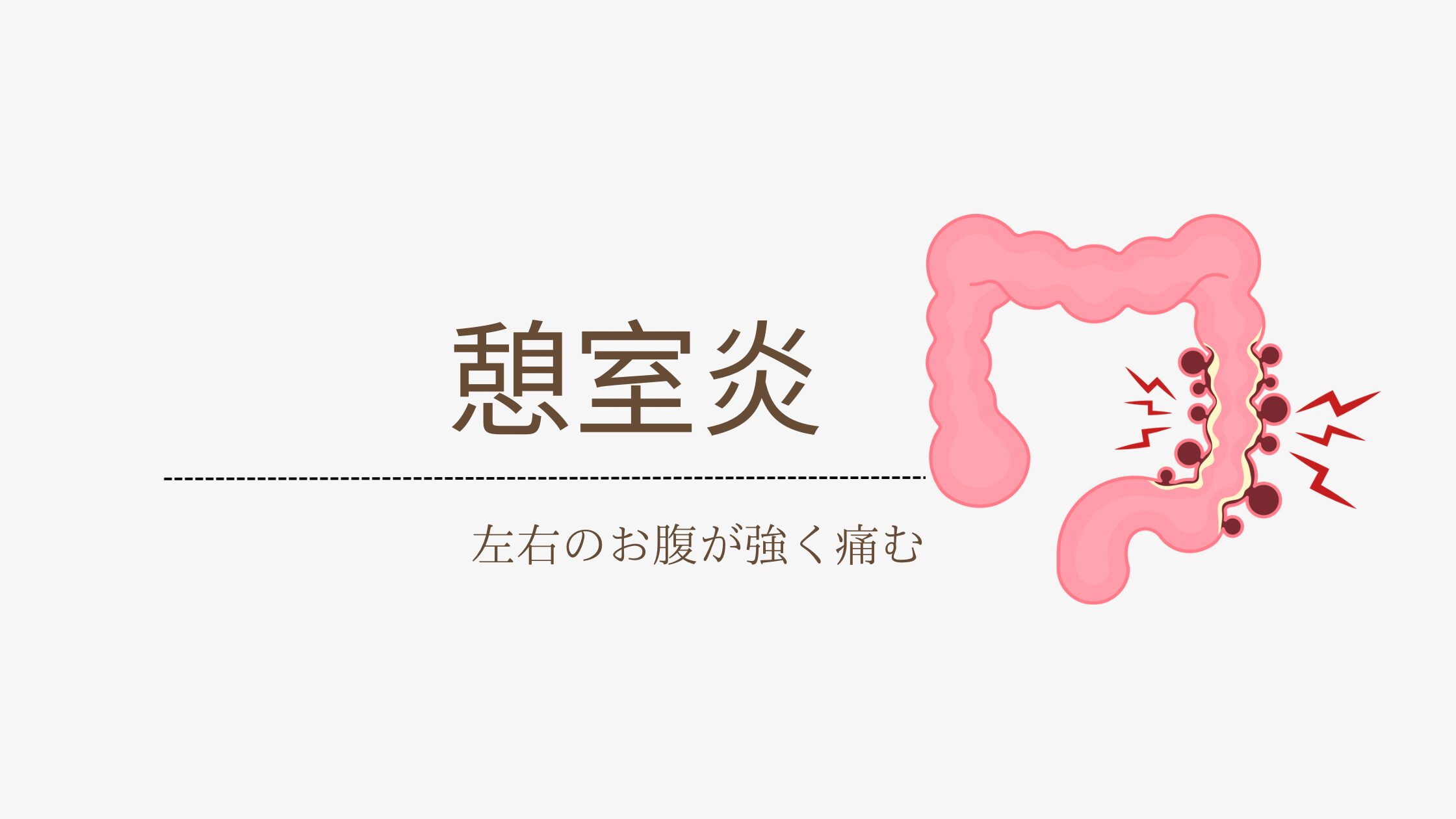 憩室炎　静岡