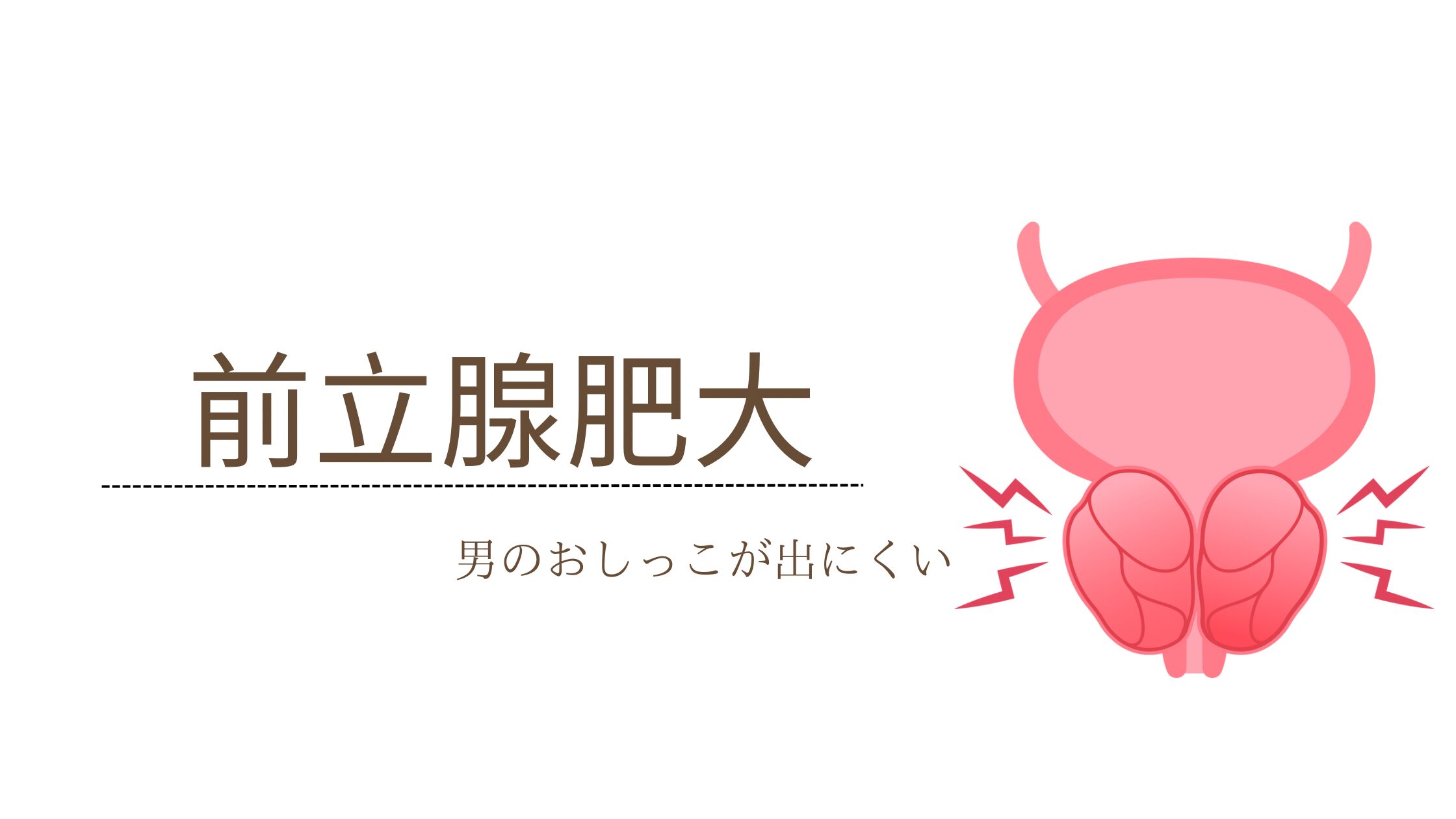 前立腺肥大