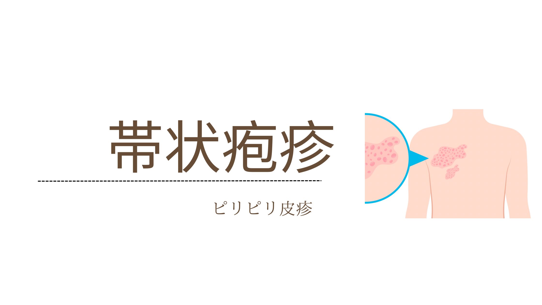 帯状疱疹とは