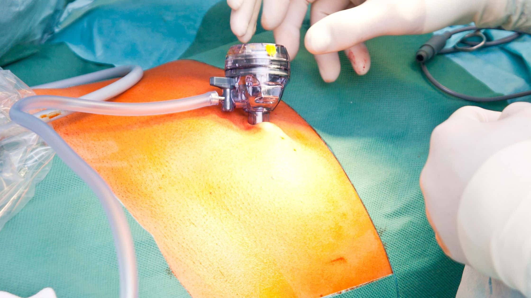 Minimally Invasive Spine Surgery
