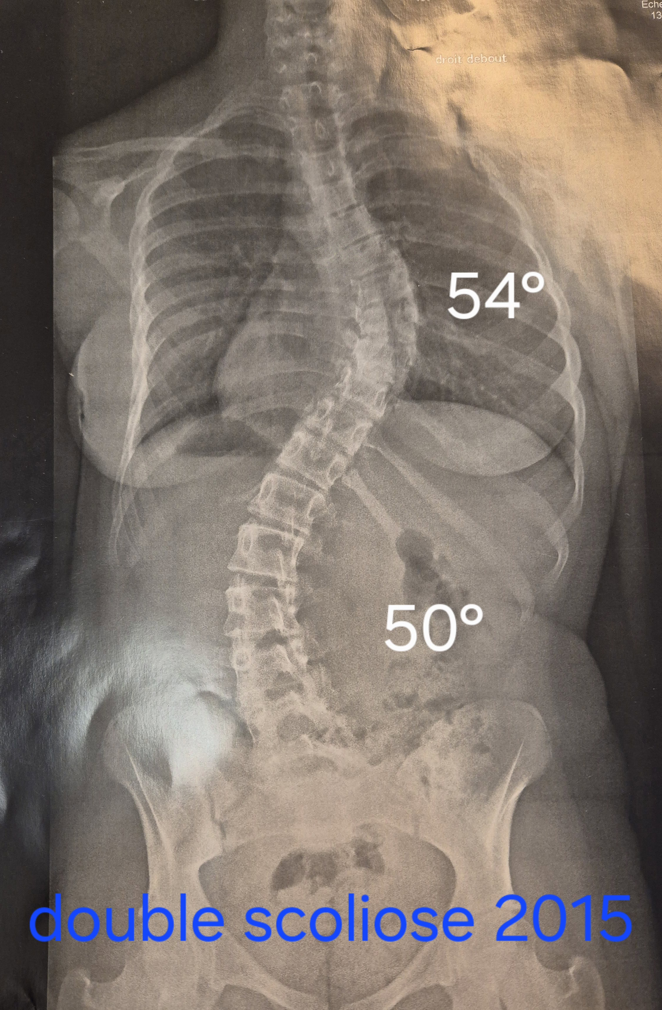 scoliose
