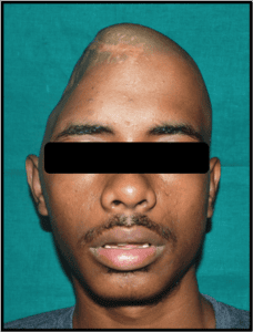 Cranial Prosthesis Before