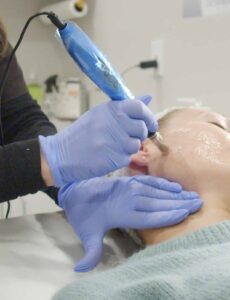 a woman gets a micro needling treatment on face