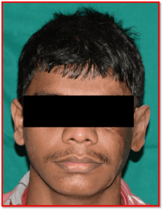 Ear Prosthesis After