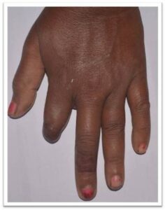 Finger Prosthesis Before