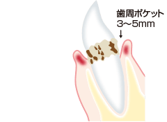 軽度歯周炎のイラスト