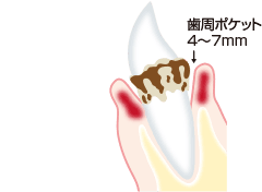 中等度歯周炎のイラスト