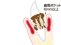 重度歯周炎のイラスト
