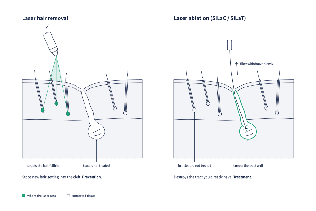 Cross-section diagram comparing laser hair removal targeting hair follicles at the skin surface with laser ablation targeting the sinus tract wall below
