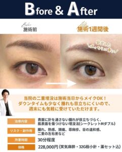 埋没法