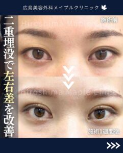二重整形