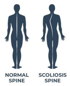 A norma spine vs a spine with scoliosis