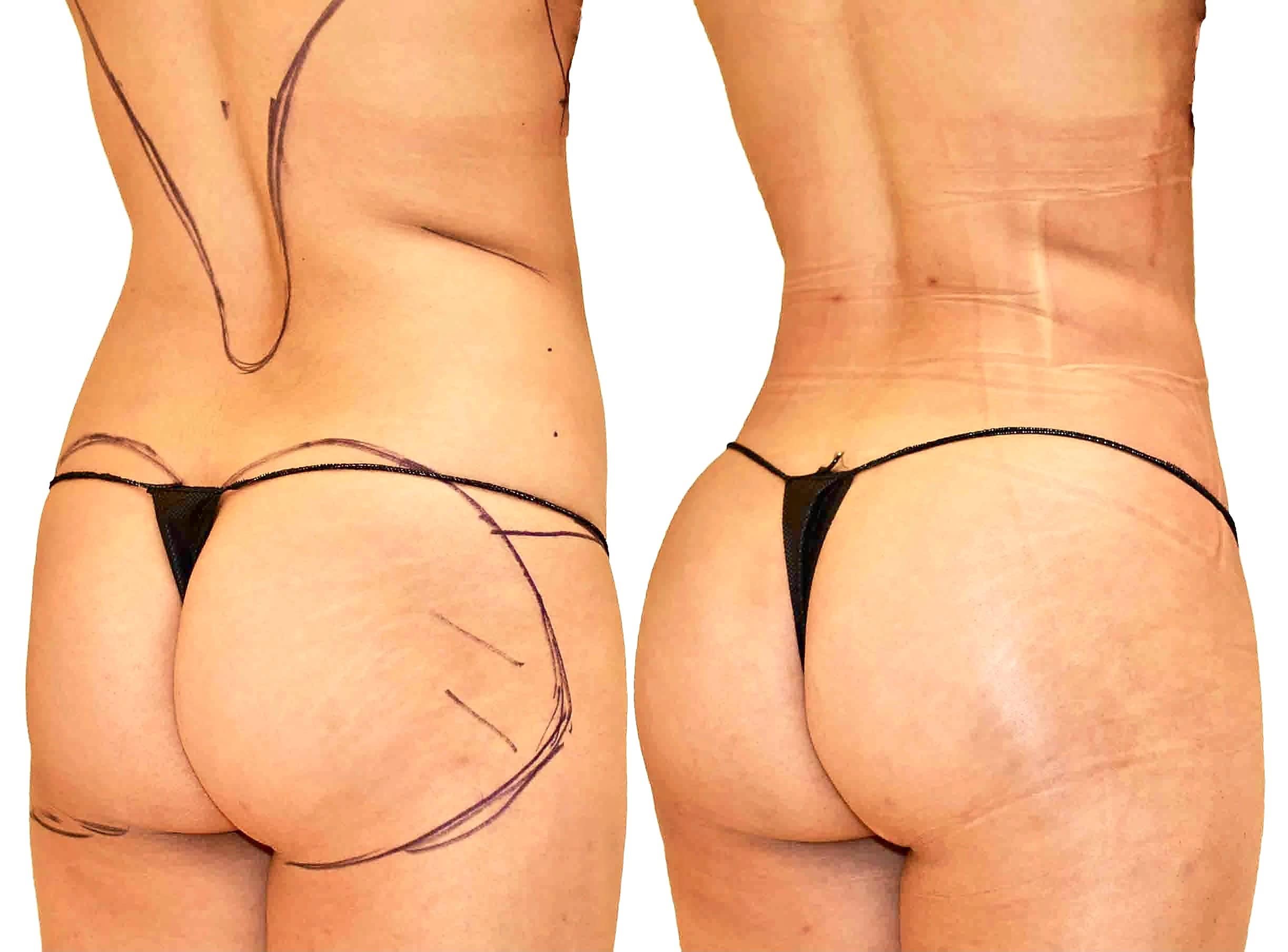 Fat transfer (BBL) before and after, Dr. Nathan Long, Dallas
