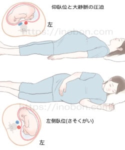 横になって眠る妊婦、妊娠中の大静脈の圧迫