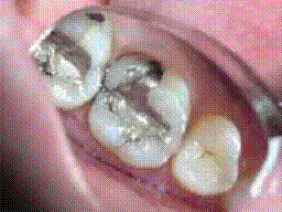 Restorations-of-teeth-using-different-filling-materials-Silver-amalgam-filling