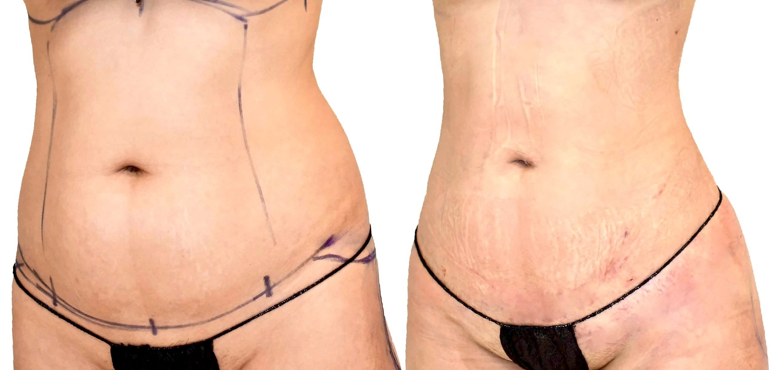 Lipo 360 before and after, actual patient of Dr. Long