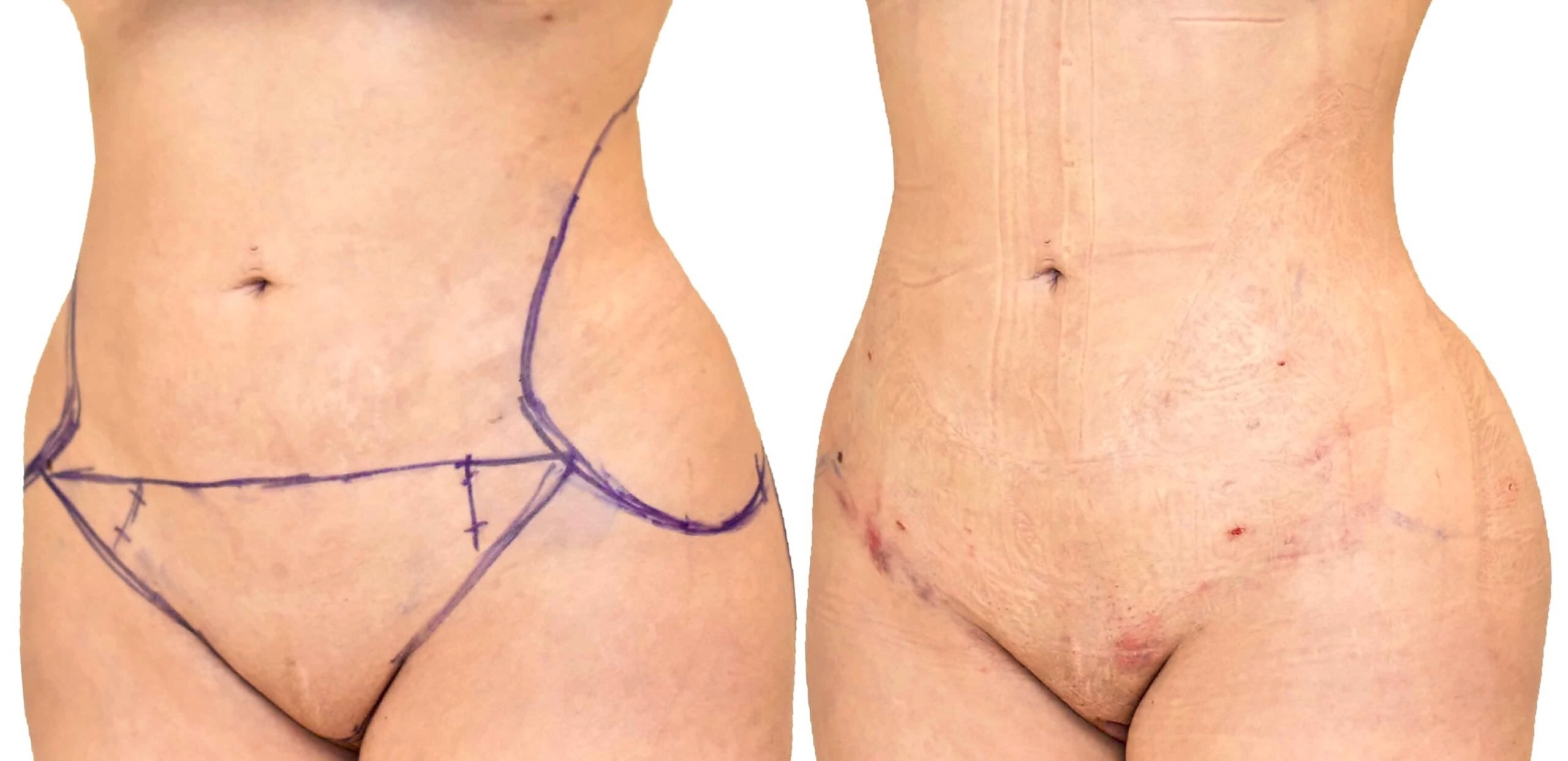 Lipo 360 before and after, actual patient of Dr. Long