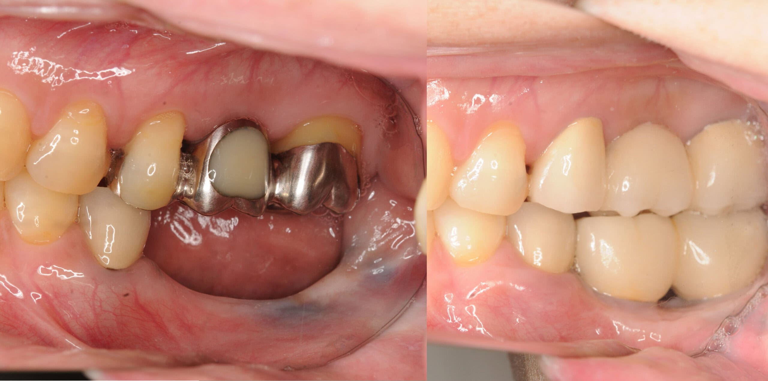 インプラント症例：51歳女性のケース