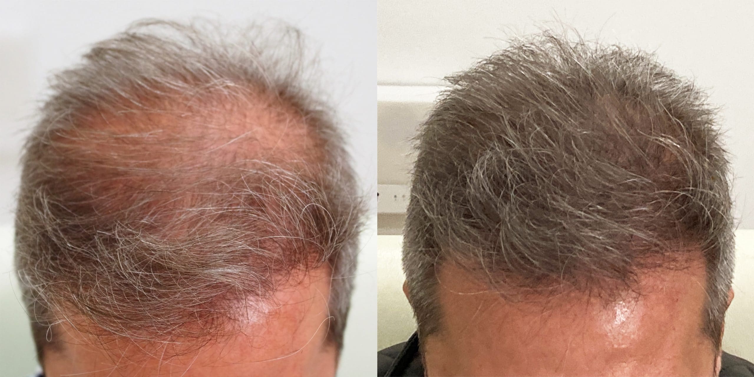 Mesoterapia capilar contra la caída del cabello en Clínica Fontana Valencia