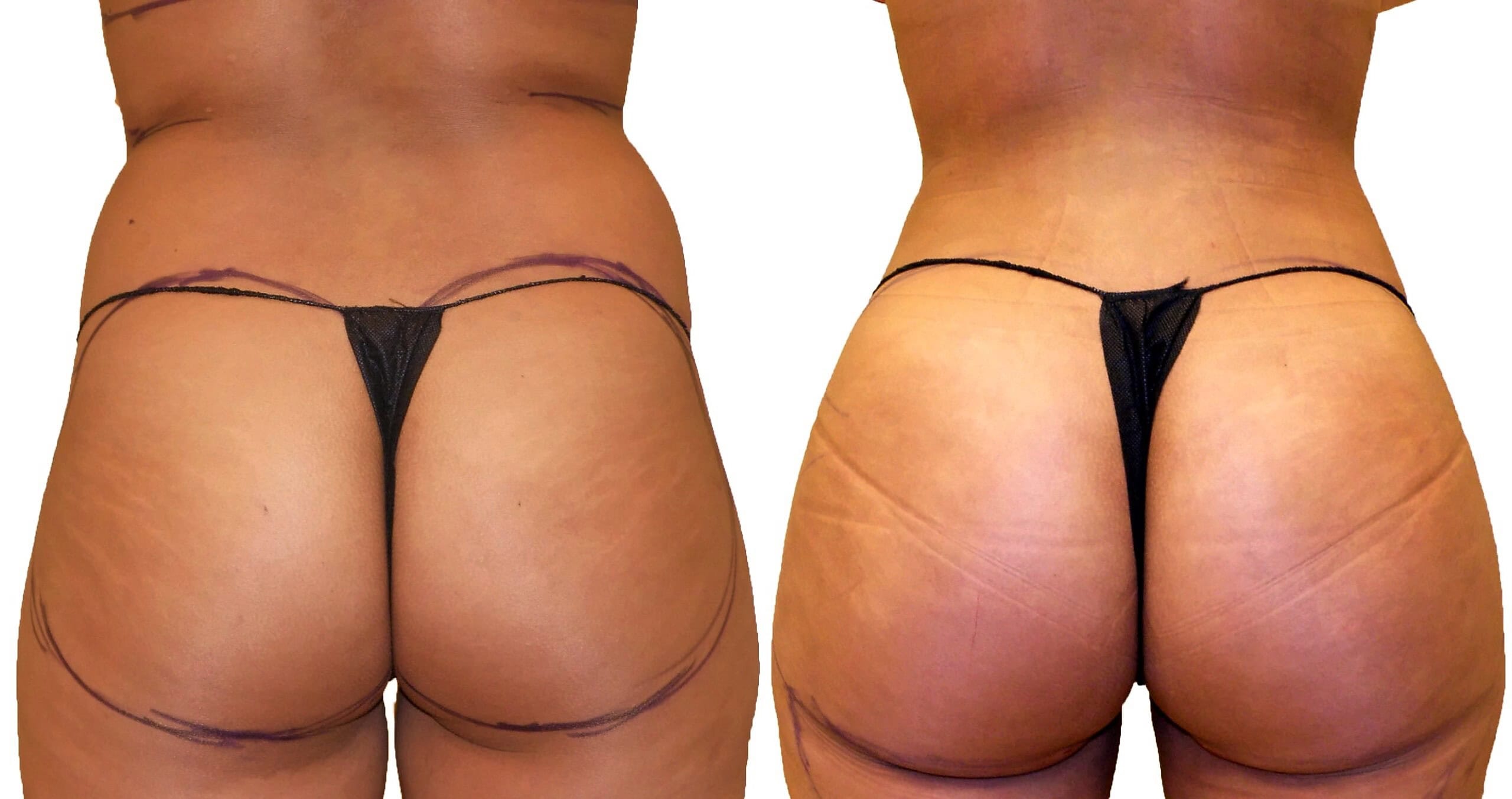 Fat Transfer, BBL before and after, actual patient of Dr. Long