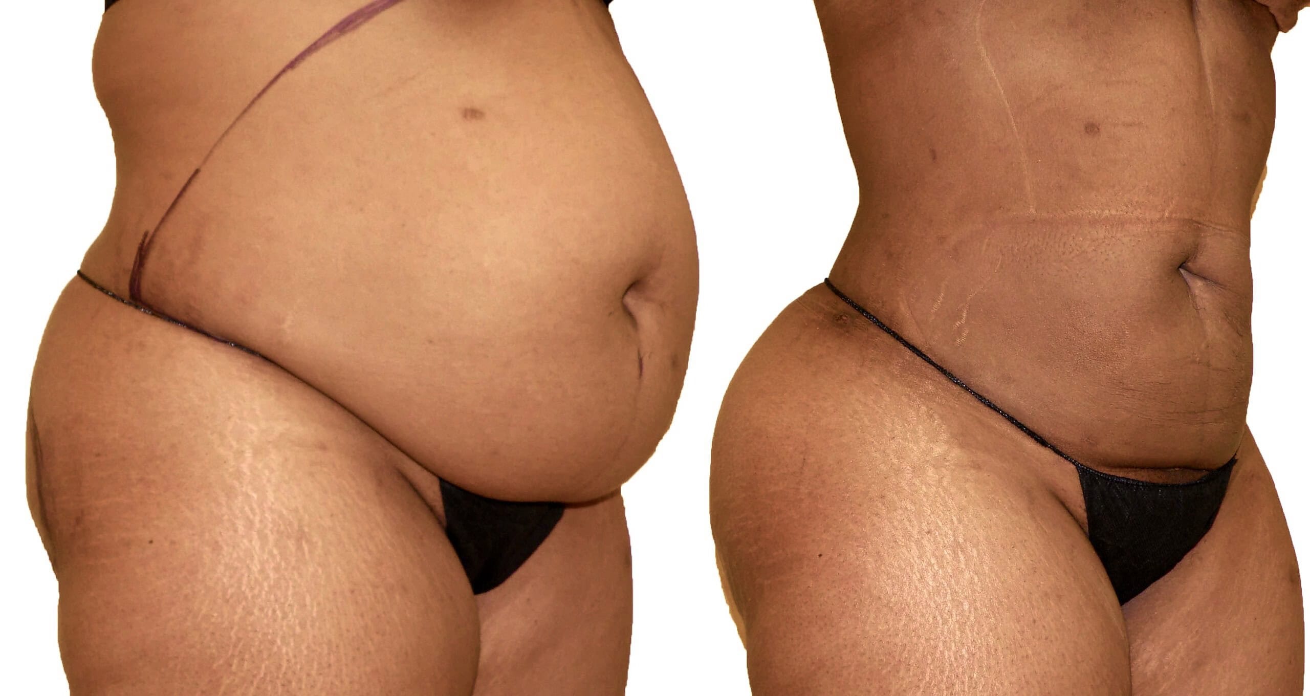 Lipo 360 before and after, actual patient of Dr. Long