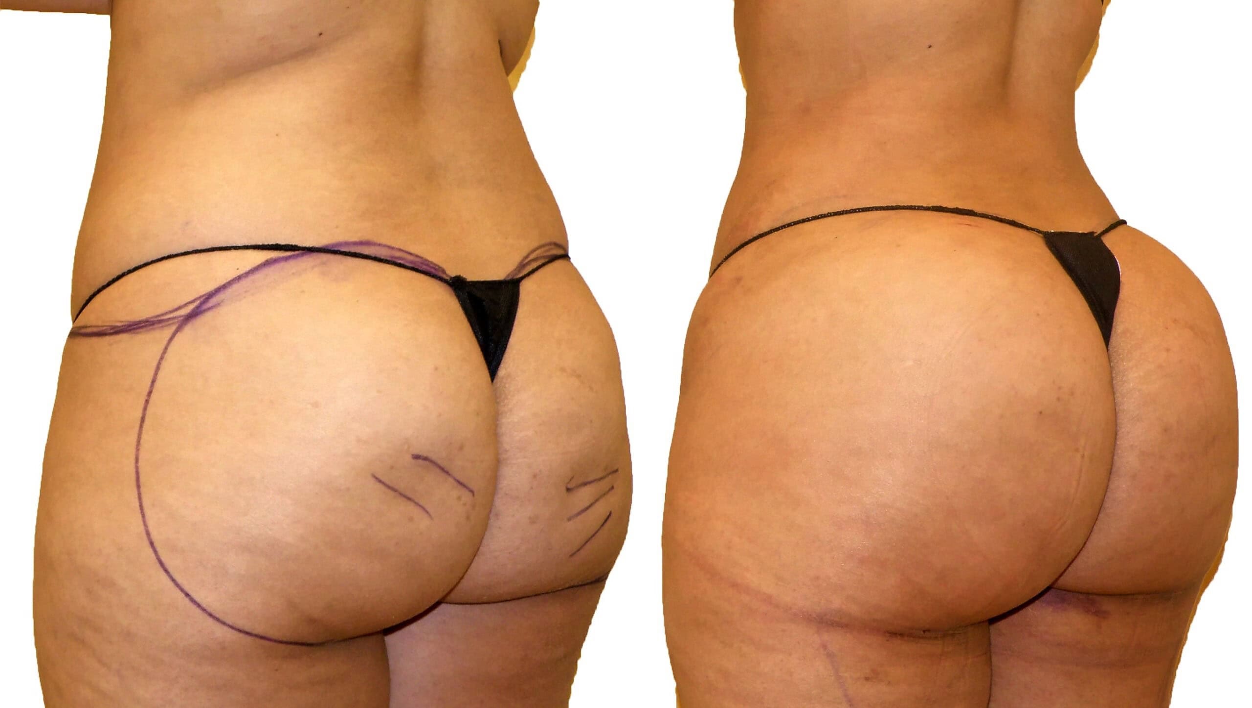Fat Transfer, BBL before and after, actual patient of Dr. Long