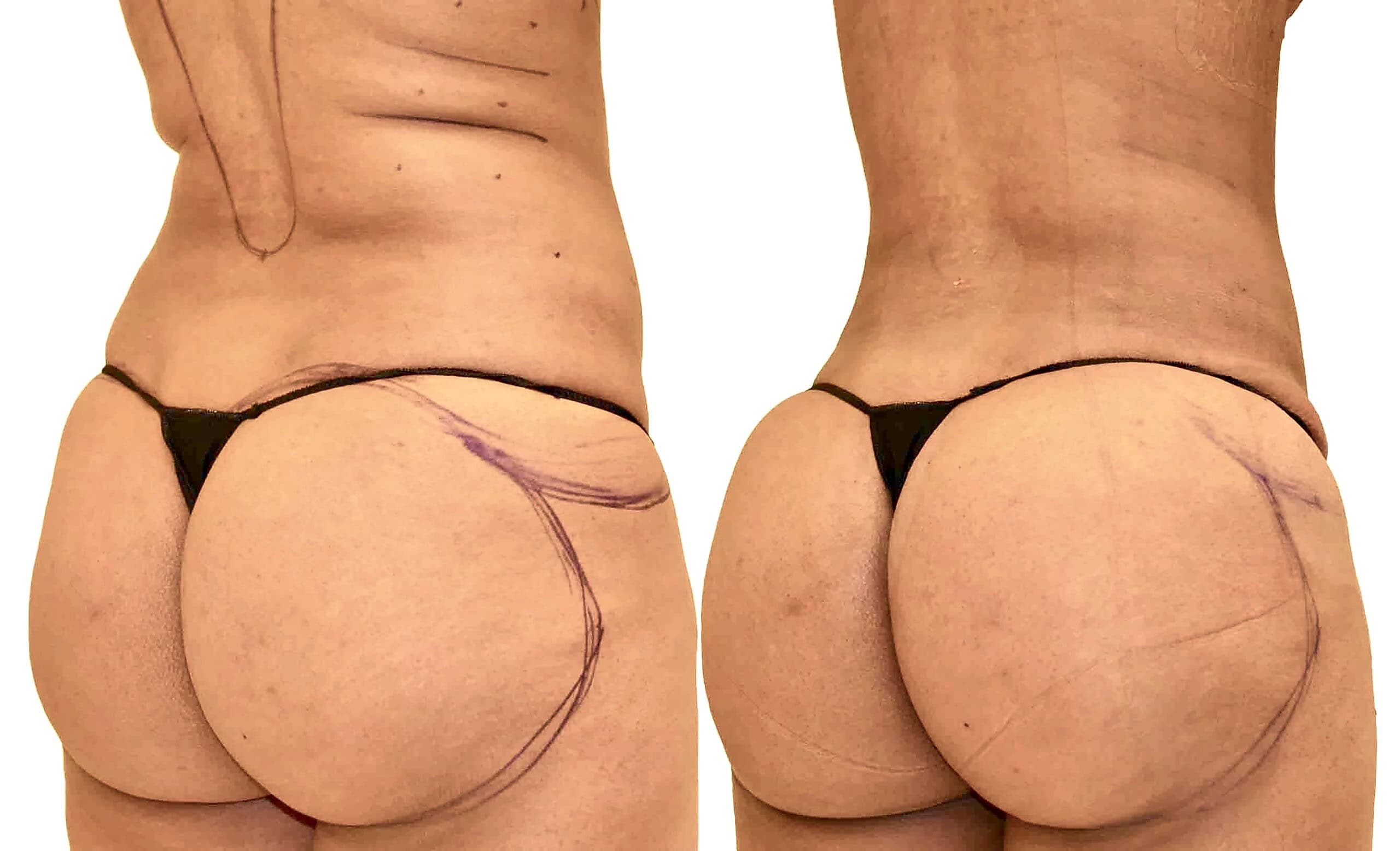 Fat Transfer, BBL before and after, actual patient of Dr. Long